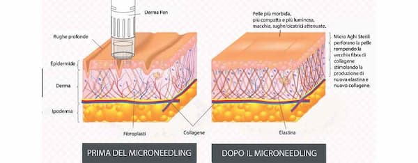 Illustrazione che mostra la pelle prima e dopo il trattamento di microneedling: a sinistra la pelle con rughe e segni visibili, a destra la pelle più liscia, compatta e luminosa grazie alla stimolazione di collagene ed elastina.